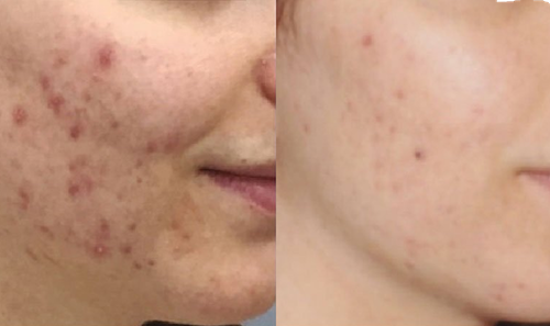 before after hyperpigmentation reduction mississauga oakville
